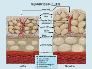 get-rid-of-cellulite