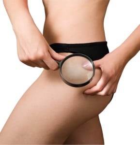Best cellulite treatment