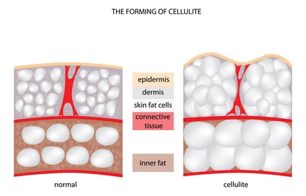 Cellulite Formation Diagram
